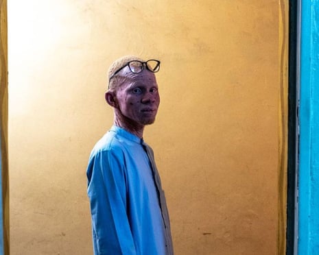 Albinism project by Maroussia Mbaye.