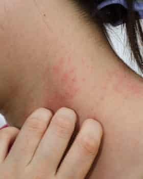 Everything You Ve Ever Wanted To Know About Eczema But Were Too Busy Scratching To Ask Health Wellbeing The Guardian Everything You Ve Ever Wanted To Know About Eczema But Were Too Busy Scratching To Ask Health Wellbeing The Guardian