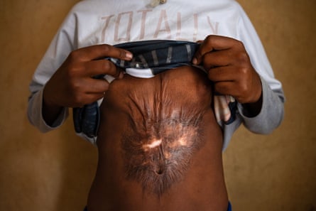 A girl, her face hidden, lifts her t-shirt to reveal a large area of scar tissue, the top area in particular puckered and tight.