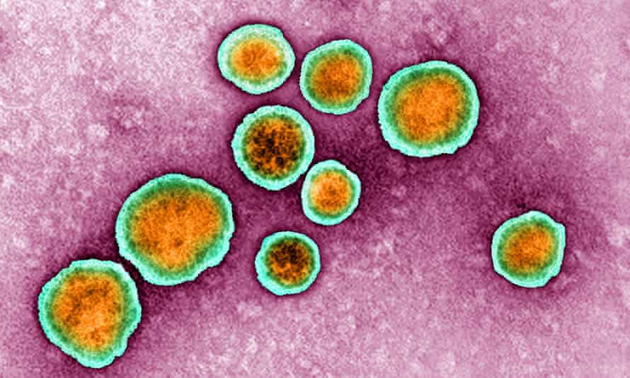 Respiratory syncytial virus (RSV) seen through a microscope.