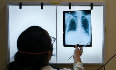 A doctor checks a patient with TB's chest X-rays during a routine consultation at the Médecins Sans Frontières (MSF) clinic in Mumbai.