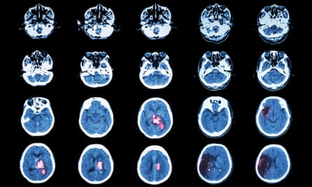 Grey matters … a CT scan shows a stroke’s effect.