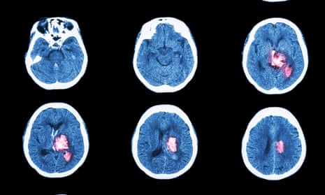 CT scans, such as these, are more routinely used to diagnose stroke. But because ultrasound scanners can be made portable, it has advantages for doctors operating outside hospitals.