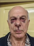 Man with bruised face.