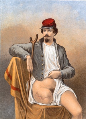 A veteran of the American Civil War with his right leg amputated at the hip