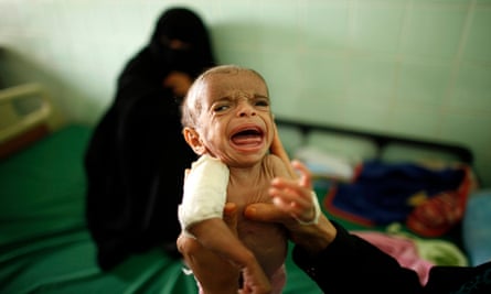 A doctor holds a malnourished boy as his mother watches in the southern Yemeni city of Taiz.