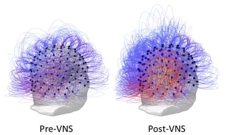 Information sharing across all electrodes before and after vagus nerve stimulation (VNS). On the right, the warmer colours indicate an increase in connectivity among brain regions responsible for planned movements, spatial reasoning and attention.