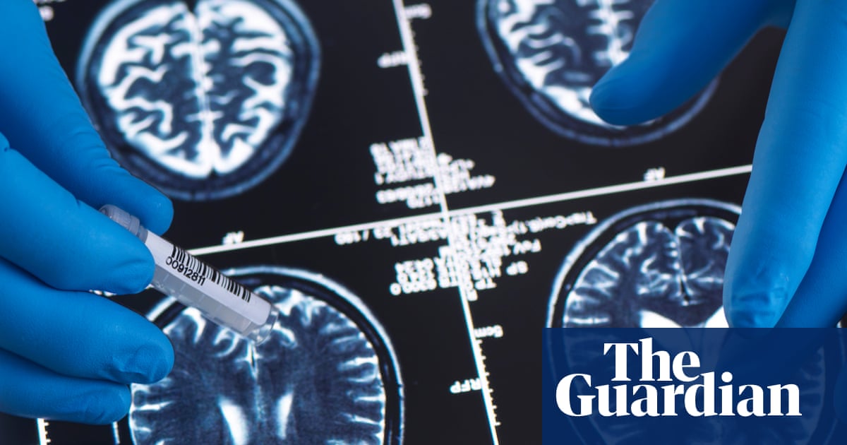 Younger generations less likely to have dementia, study suggests