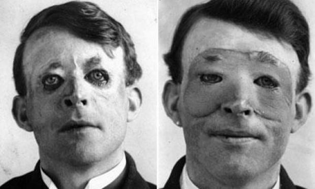 Walter Yeo is thought to be the first person to benefit from advanced plastic surgery after he was wounded in the Battle of Jutland in 1916. He was treated by Sir Harold Gillies.