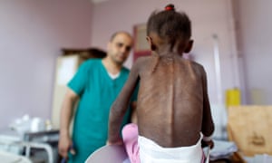 A nurse looks on as a malnourished girl is weighed at a malnutrition treatment centre in Sana’a, Yemen