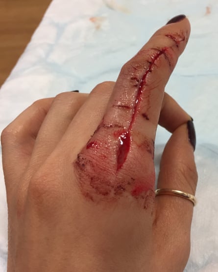 Left index finger with a deep cut wound from fingertip to knuckle. Bloodied with stitches.
