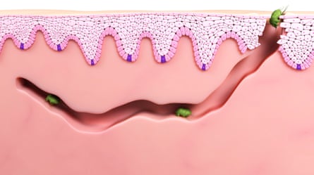 Computer artwork of scabies mites (Sarcoptes scabei) burrowing into the skin.