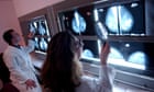 NHS replaces highest-spend drug with £300m cheaper alternative