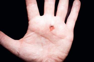 a person's palm with a bloodied squashed mosquito on it
