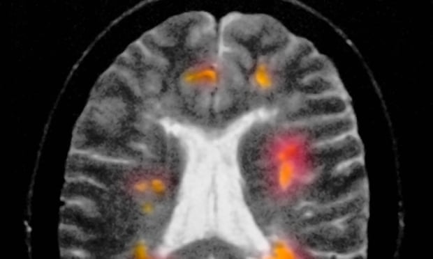 A MRI scan shows a patient with multiple sclerosis. The disease destroys the protective myelin coating of nerves in the brain and spinal cord.