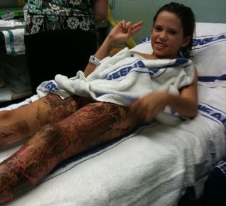 Rachael Shardlow after being stung by a box jellyfish.