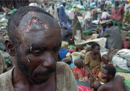 A refugee with a machete wound in Kibeho, Rwanda, in 1995