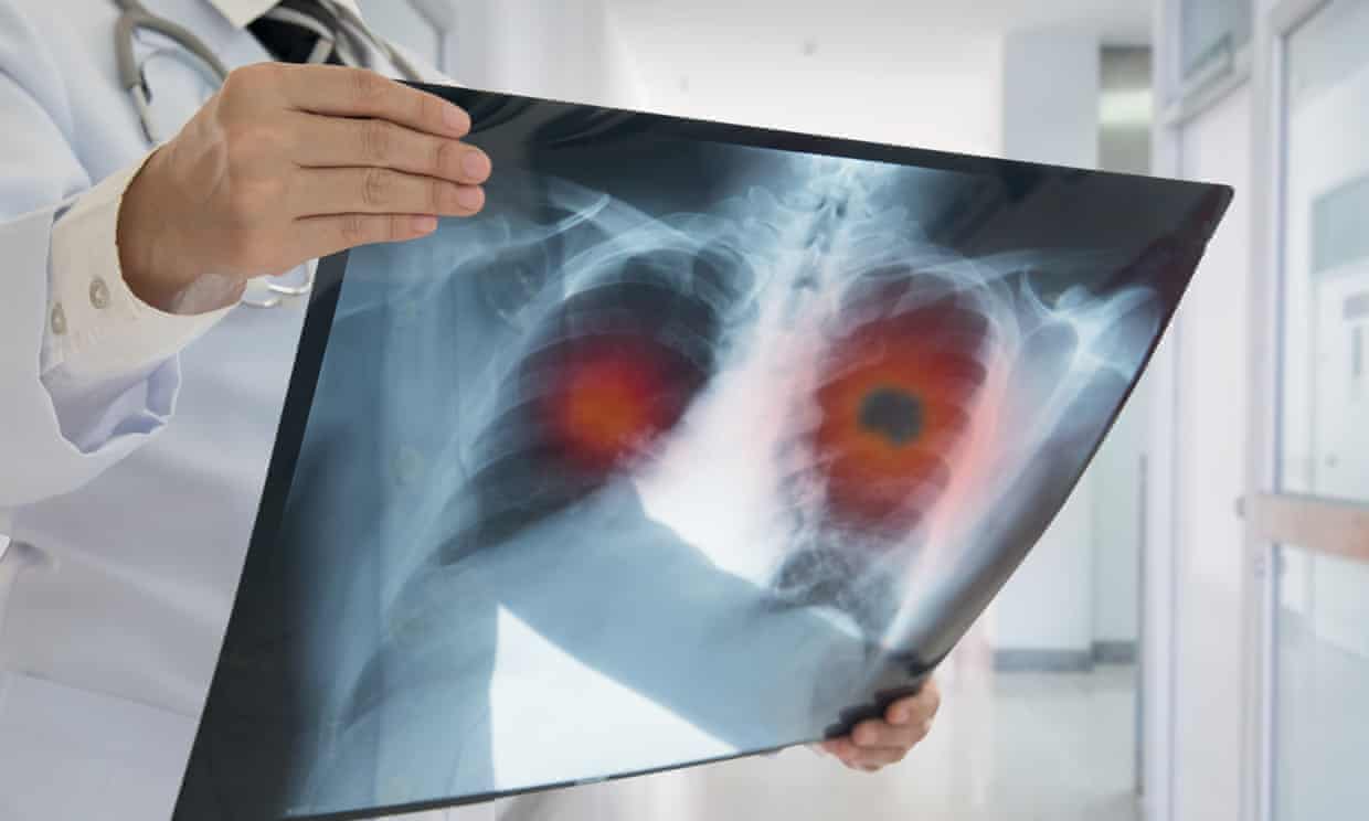 Lung cancer pill cuts risk of death by half, says ‘thrilling’ study (theguardian.com)