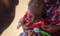 The arm size of a Sudanese child suffering from malnutrition is examined at a refugee camp in Chad.
