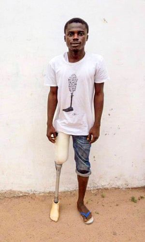 Mohamad Musa had his leg removed in 2014 after suffering pain for many years.