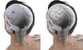 Two cutaway drawings showing a brain inside a skull, the sceond with a thin spiral implant placed on the left hemisphere