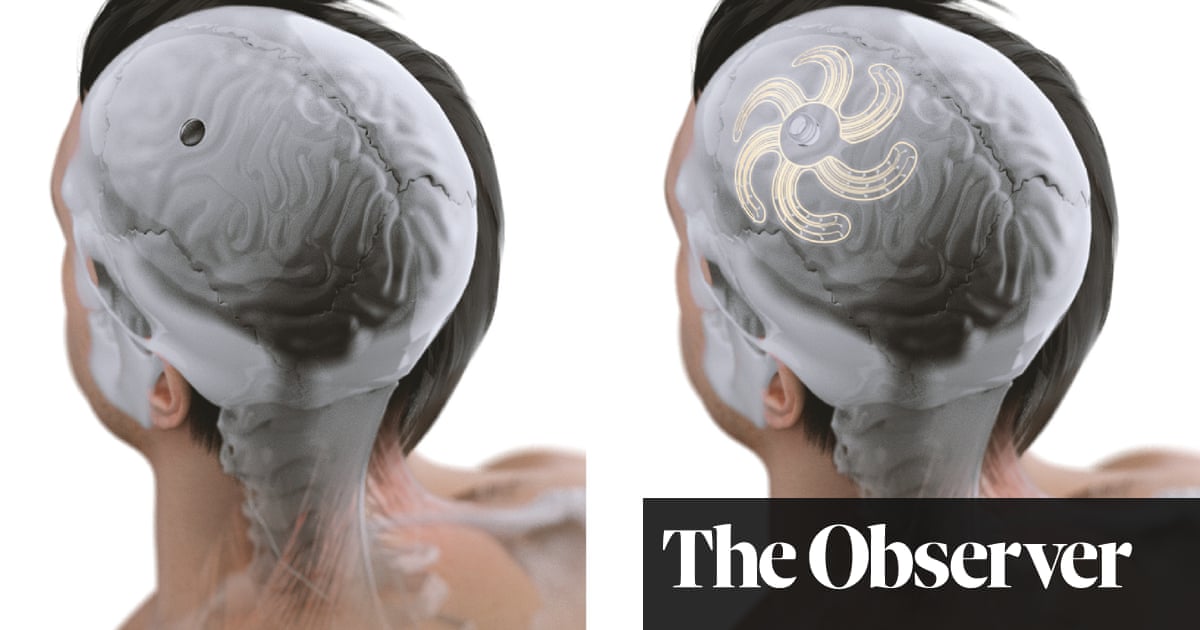 Brain implants to treat epilepsy, arthritis, or even incontinence? They ...