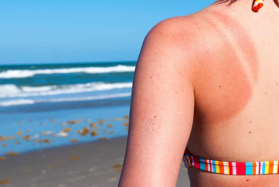 Jeune femme à l'épaule brûlée par le soleil à la plage