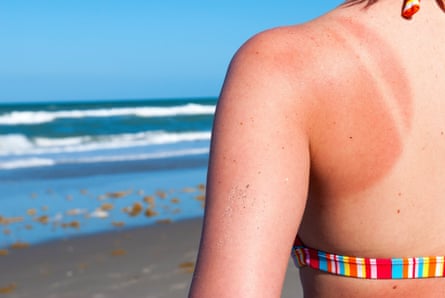 Young woman with sunburned shoulder at the beach