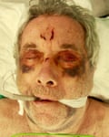 Martin Bell in hospital after the accident.