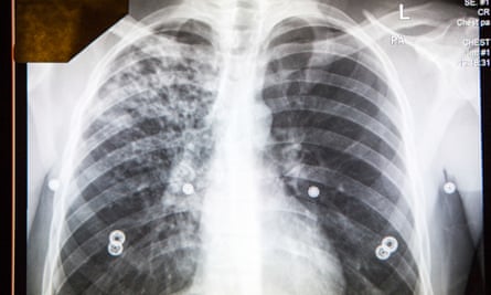 An abnormal digital chest x-ray, taken at a public health screening for TB.