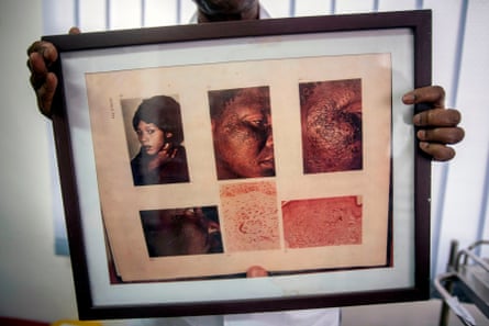 Pictures of a woman who suffers from ochronosis, linked to a long-term application of skin-lightening products, in Ghana.