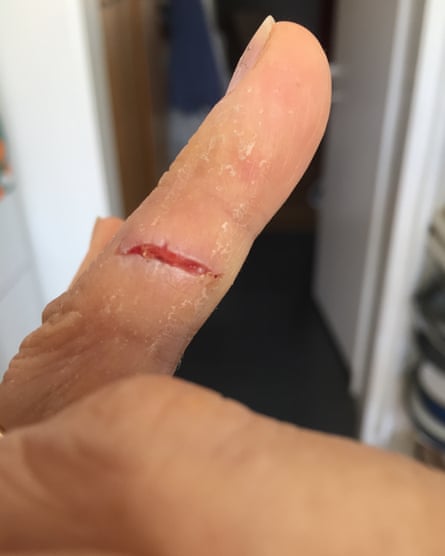 Healed cut on wedding finger.