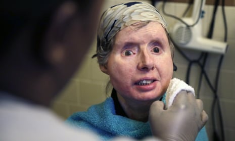charla nash face transplant chimp