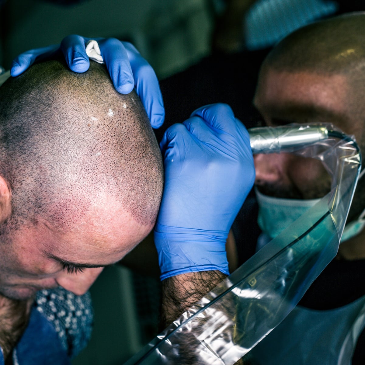 Going bald? There's a tattoo for that | Men's health | The Guardian