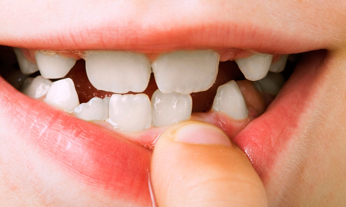 I've had to remove all of a toddler's teeth. It's time for a war on sugar | Healthcare Network | The Guardian