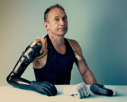 Jim Ashworth-Beaumont photographed pinch his erstwhile prosthetic limb successful October 2024