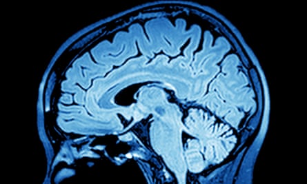 Imaging of the brain on mri scan