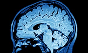 Imaging of the brain on mri scan.