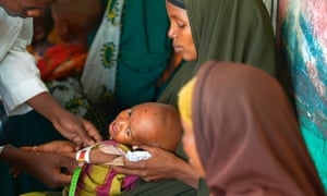 A malnourished child receives attention from an aid worker at a facility in Baidoa town, in Somalia's south-western Bay region
