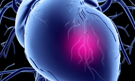 Computer artwork shows a conceptual drawing of a heart attack.