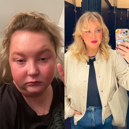 Two pictures of the same woman. The one on the left is shown bloated with a red face. The one of the right is looking healthy and taking a selfie