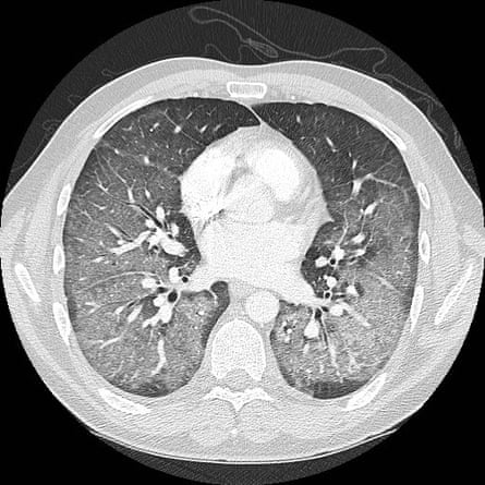 The images of the CT scans are shown looking through the body from feet. In these CT scans, there are patchy densities or cloud-like areas throughout both lungs which are seen with unusual pneumonias, lung fluid or lung inflammation.