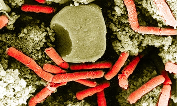 What You Need To know About Acute Infectious Anthrax?