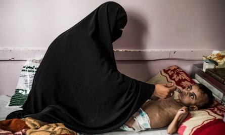 A child suffering from malnutrition at the Sabeen maternity hospital in Sana’a.