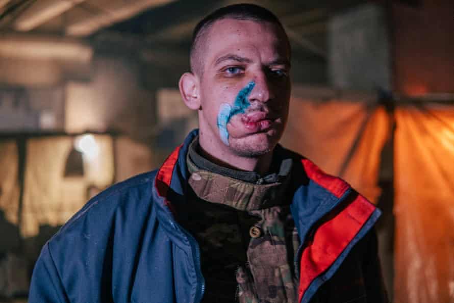 A worker with wounds inflicted connected his look seen successful bandages.