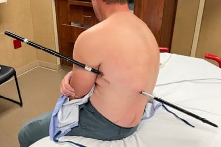 David Cifaldi before his walking stick is removed from his chest in hospital in Billings, Montana.