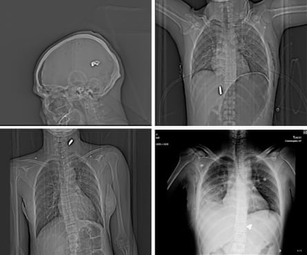 Composite of four X-ray images showing bullets embedded in a skull, neck, spine and chest.