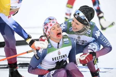 Diggins lost her right ski pole and glove and suffered a bleeding gash with about one mile left in a 20km freestyle race earlier this season in Ruka, Finland. She still managed to finish in second.