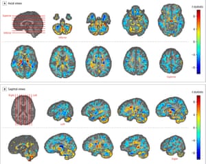 Il cervello scansiona rivelando le differenze nel volume della materia bianca e grigia tra i pazienti dell'ambasciata americana a L'Avana e controlli sani. Le regioni da giallo a rosso mostrano aree di volume maggiore nei pazienti, mentre il ciano a blu segna aree di volume inferiore nei pazienti rispetto ai controlli.