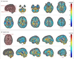 Il cervello scansiona rivelando le differenze nel volume della materia bianca e grigia tra i pazienti dell'ambasciata americana a L'Avana e controlli sani.  Le regioni da giallo a rosso mostrano aree di volume maggiore nei pazienti, mentre il ciano a blu segna aree di volume inferiore nei pazienti rispetto ai controlli.